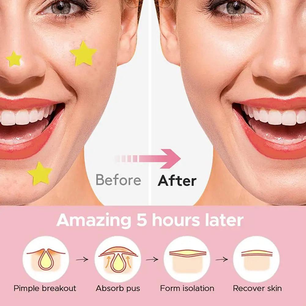 300/600pcs Star Acne Patch Mild Non-irritating Lightens Acne Hydrocolloid Acne Sticker For Blackheads Closed Comedones