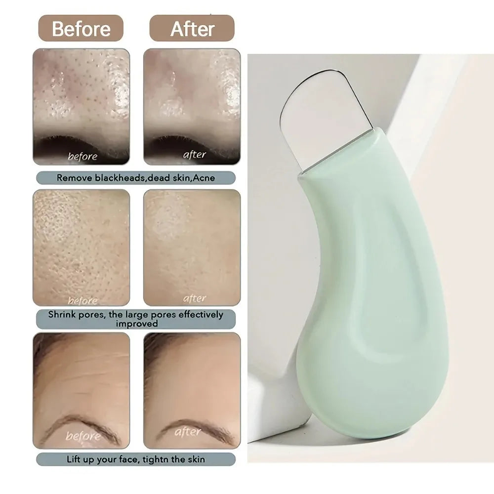 Blackhead and Whitehead Removal Tool for Nose and Face - Skin Pore Cleaner Skin Care Tools for Women