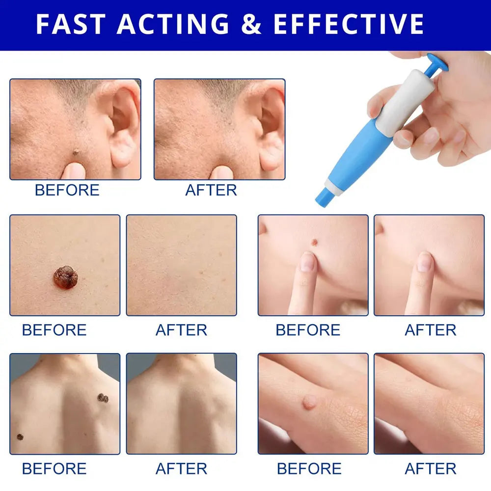 Trade Double Head Wart Remover Pen Skin Skin Tag Removal Kit Home Use Face Skin Care Tool