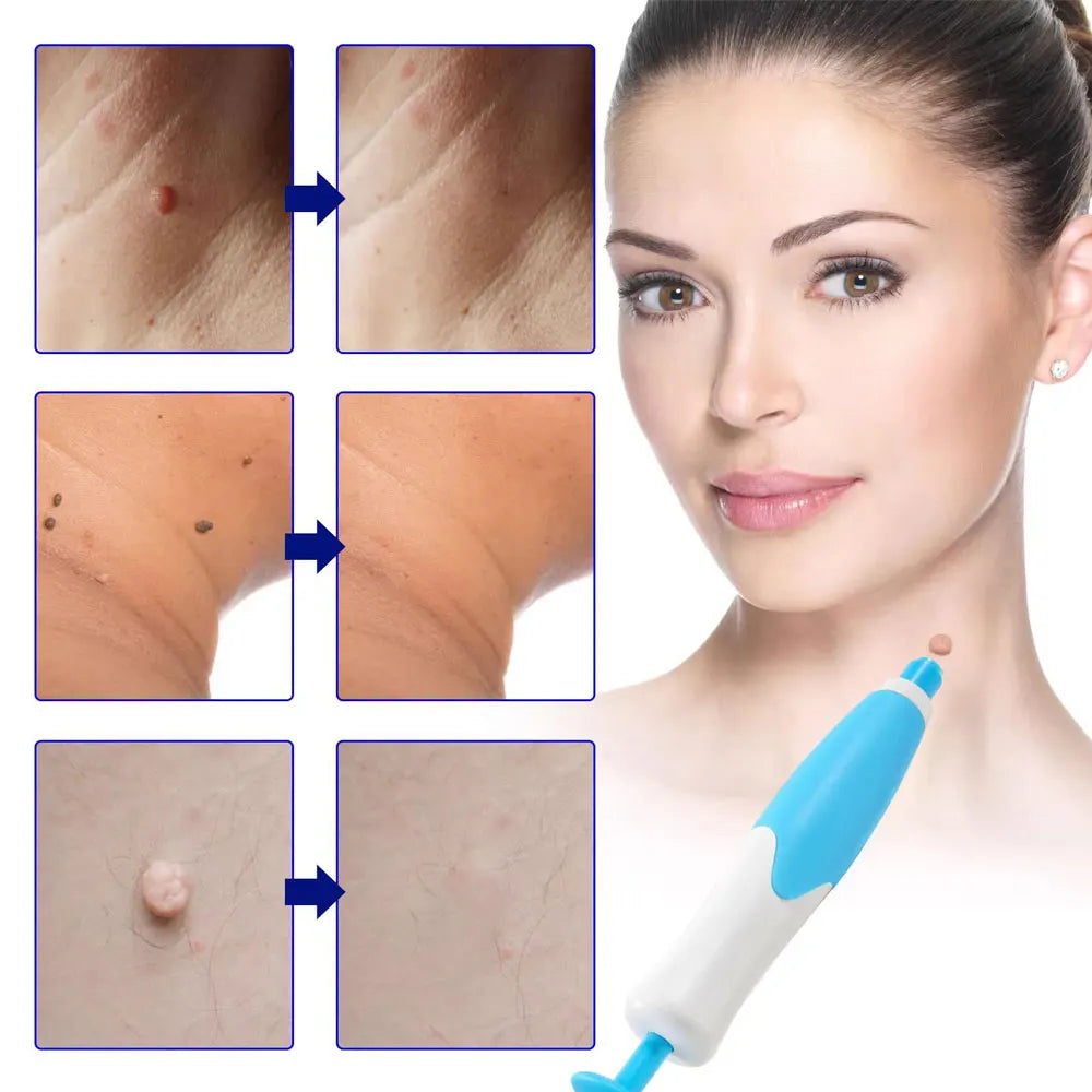 Trade Double Head Wart Remover Pen Skin Skin Tag Removal Kit Home Use Face Skin Care Tool