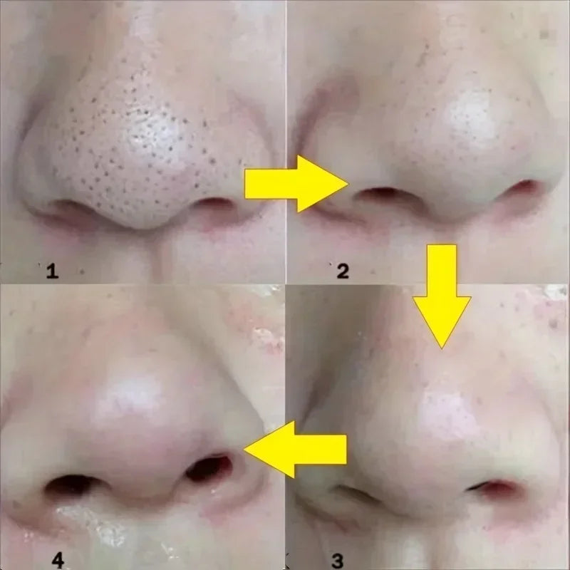 10-100pcs Blackhead Nose Strips Deep Cleansing Nasal Spot Facial Dot Stickers Nose Mask Shill For Acne & Black Head - Dropship